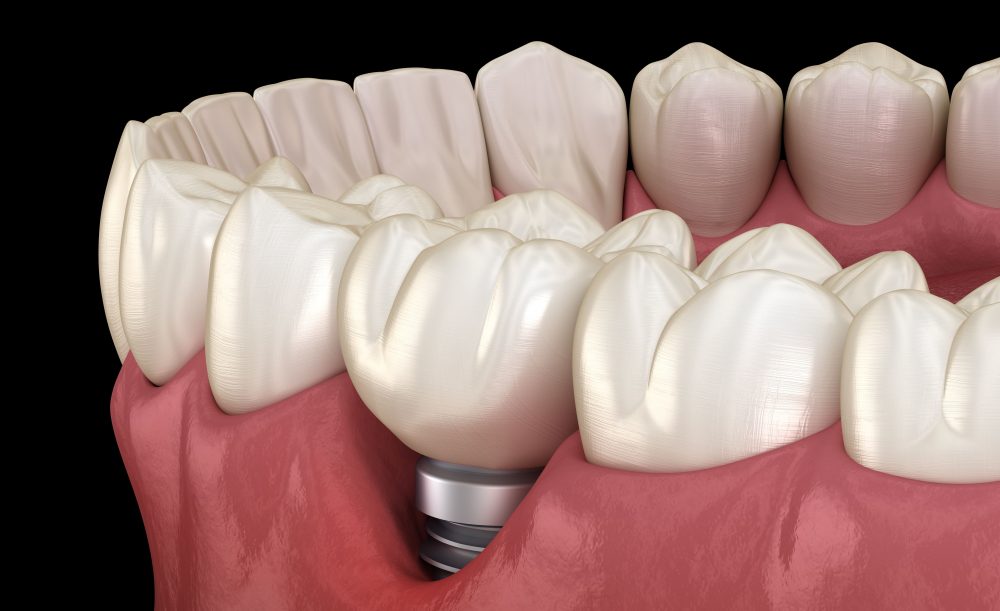 Diagnosis, Treatment and Prevention of Peri-implantitis